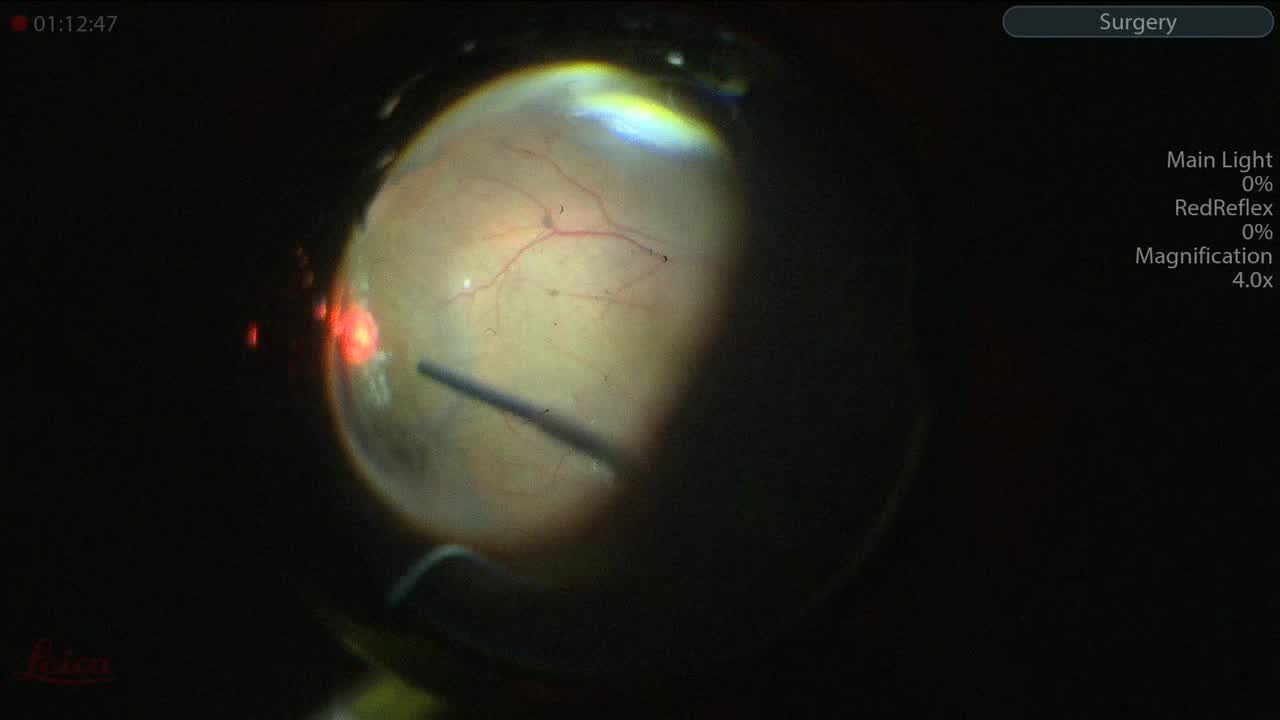 Complicated Shallow Retinal Detachment - Eyetube