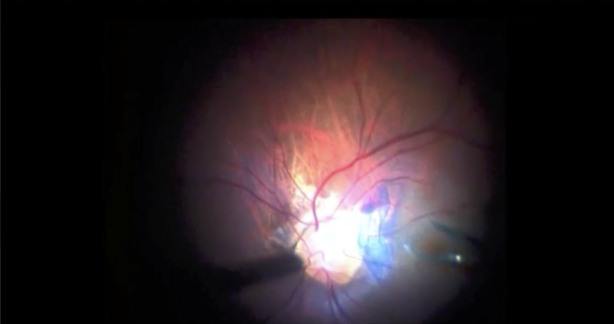 Optic Nerve Pit