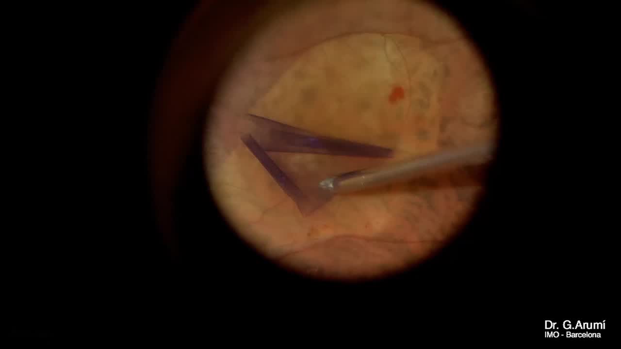 Macular Schisis and Macular Hole