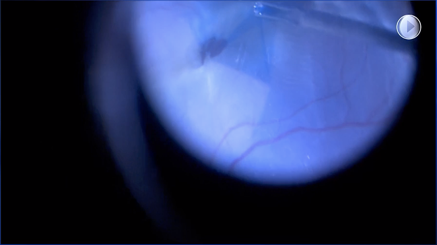 Giant Tear