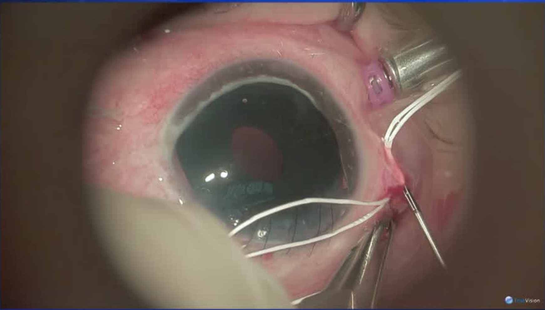 Artificial Iris