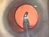 CapsuleGuard I/A Handpiece with Surgical Procedures