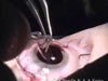 PK, ECCE, and IOL Open Sky Triple Procedure