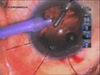 Traumatic Cataract with Dangling, Subluxated Lens