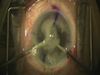 Posterior Capsular Rent With Reverse Optic Capture of a Toric IOL