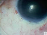Anterior chamber maintainer