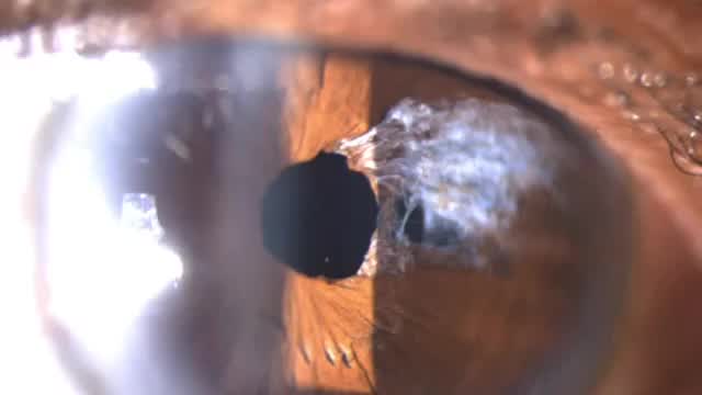 Frayed Iris with Buttonhole Repair