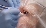 Ozurdex Precision Program: Video Guide to Injection Technique