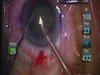 My First Case With SoftFit Patient Interface for the LenSx Laser