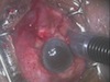 TSCPC with the Iridex G-Probe