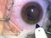 Cataract Removal and Lens Repositioning in Marfans Syndrome Case