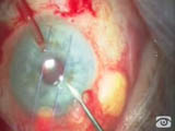 Scleral Sulcus Tube Insertion 