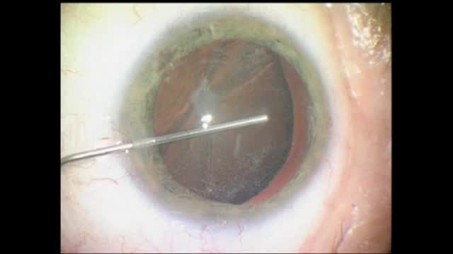 Traumatic Zonular Dialysis