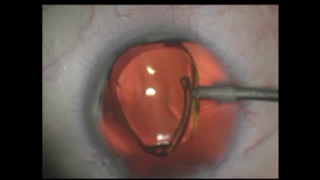 Anirldia/Irs Prosthesis