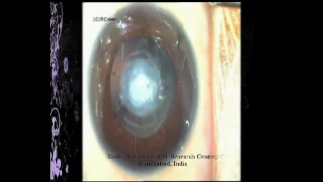 Posterlor Capsular Piague