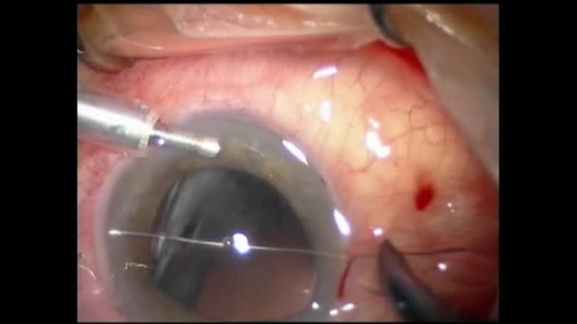 Safety Suture Technique 