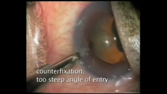 Phaco Bloopers 