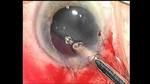 Expulsive Hemorrhage #1