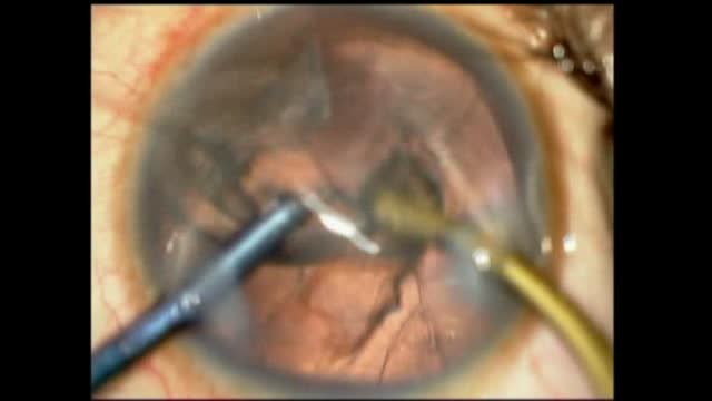 Expulsive Hemorrhage #2