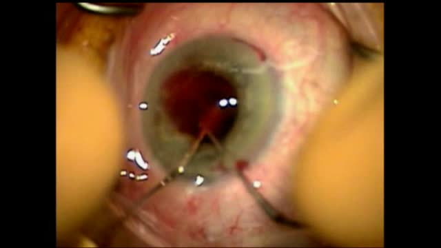 Expulsive Hemorrhage #3