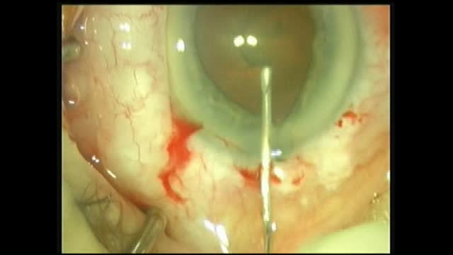 Aborted Case 