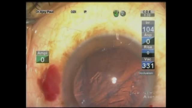 Posterior Capsule Tear 