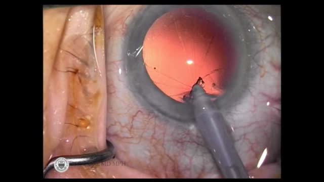 Capsular Bag Prolapse 