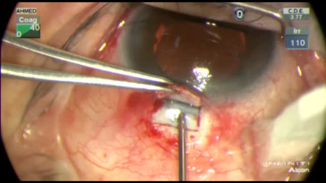 Ike K. Ahmed, MD demonstrates a spectrum of new technology including: Express Filtration Devices, SOLX Gold MicroShunt, Canaloplasty, Endocyclophotocoagulation, Cypass, iStent and Trabectome