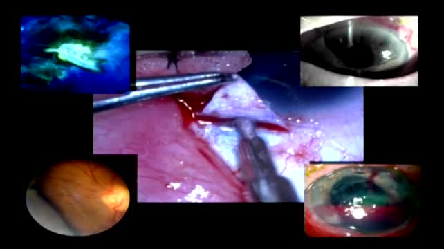 Minimally Invasive External Mini-Glaucoma Shunt Implantation Without Conjunctival Dissection