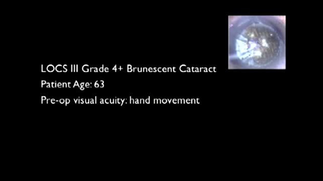 Femto for Mature Cataract