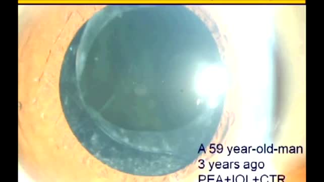 Modified Capsule Expander - Eyetube