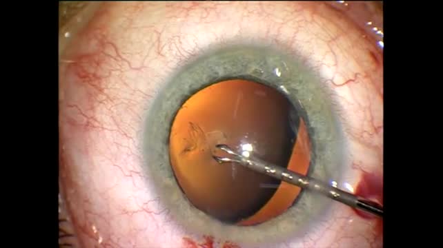 Marfan's Syndrome
