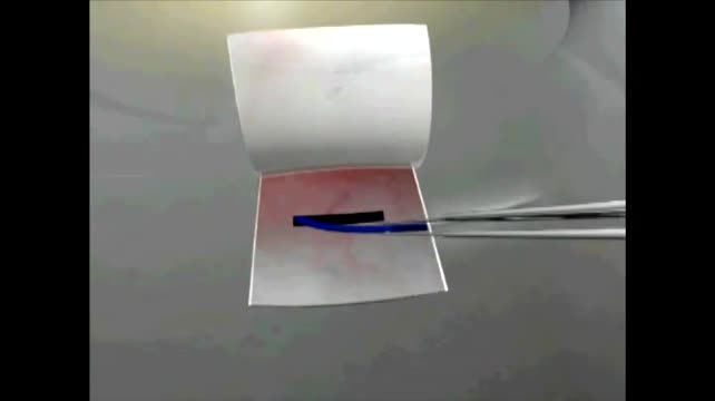 Endocapsular Hemi-Ring