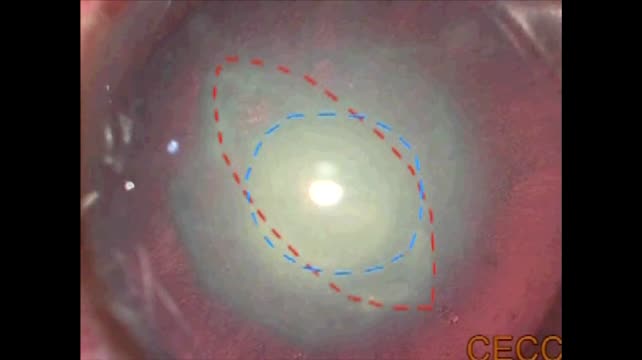 Posterior Polar Cataract