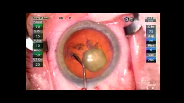 Posterior Polar Cataract