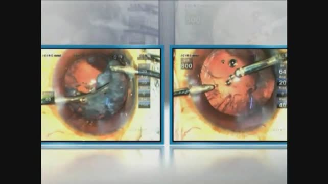 Many Faces of the Anterior Vitreous