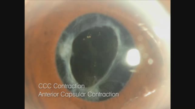 New Concept to Prevent Anterior Capsulorhexis Contraction
