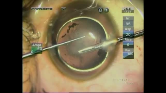 Spherophakia with Corneal Adhesion - A Surgical Challenge