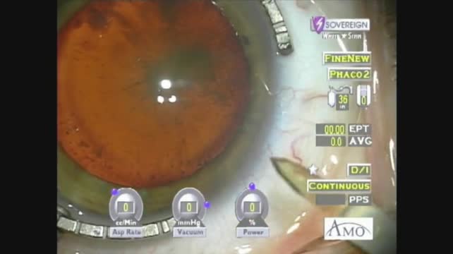 Phacoemulsification