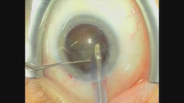 Phacoemulsification
