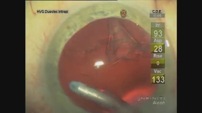Phacoemulsification