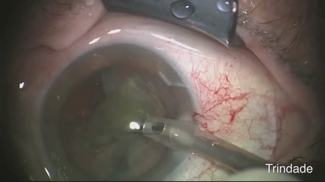 Phacoemulsification
