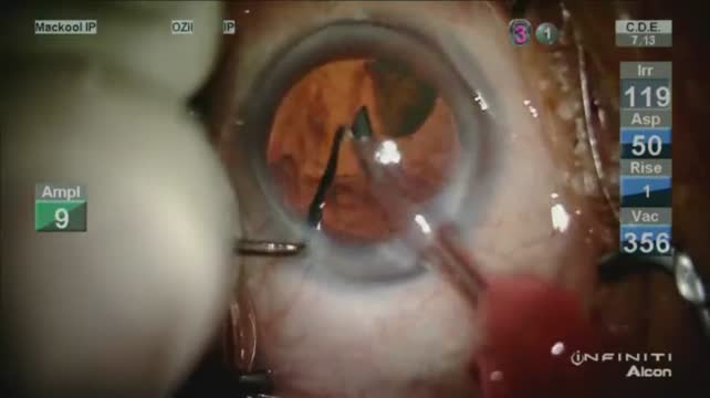 Phacoemulsification