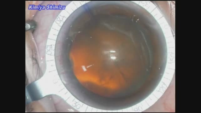 Phacoemulsification