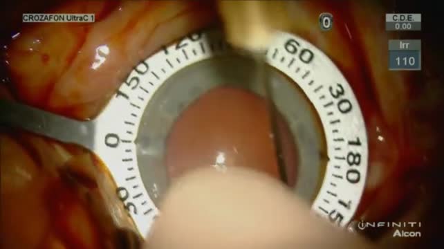 Phacoemulsification