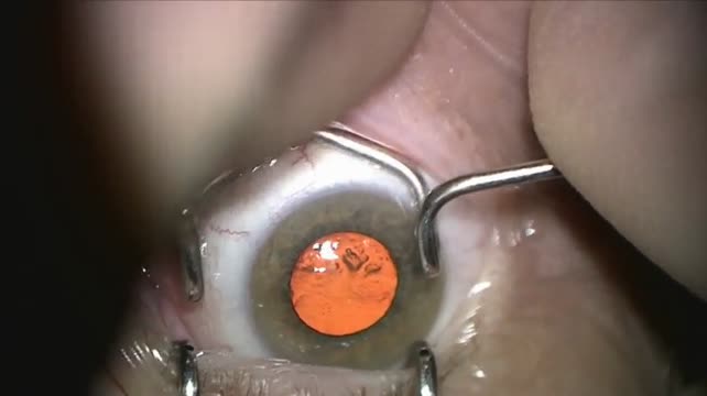 Phacoemulsification
