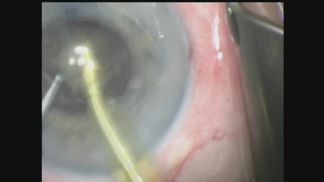 Phacoemulsification