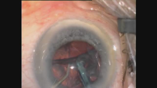 Phacoemulsification