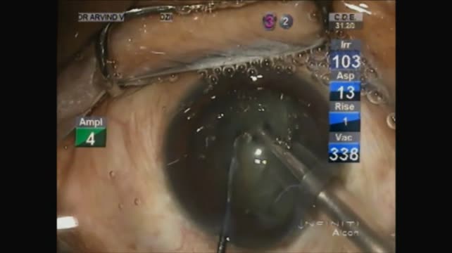 Posterior Capsular Cysts
