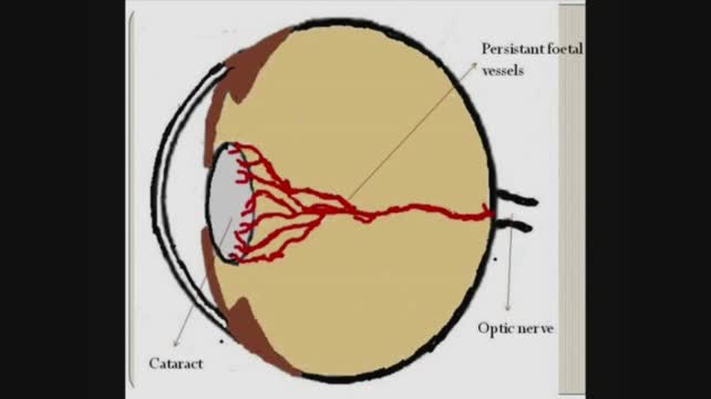 Persistent Fetal Vasculature Syndrome 